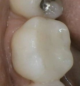 CEREC