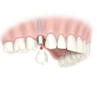 12 réponses à vos questions sur les implants dentaires
